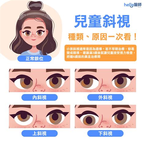 幼兒斜眼看人|斜視、鬥雞眼原因？矯正斜視不能拖，滿3歲要視力檢查